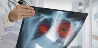 Doctor holding lung X-ray with highlighted areas
